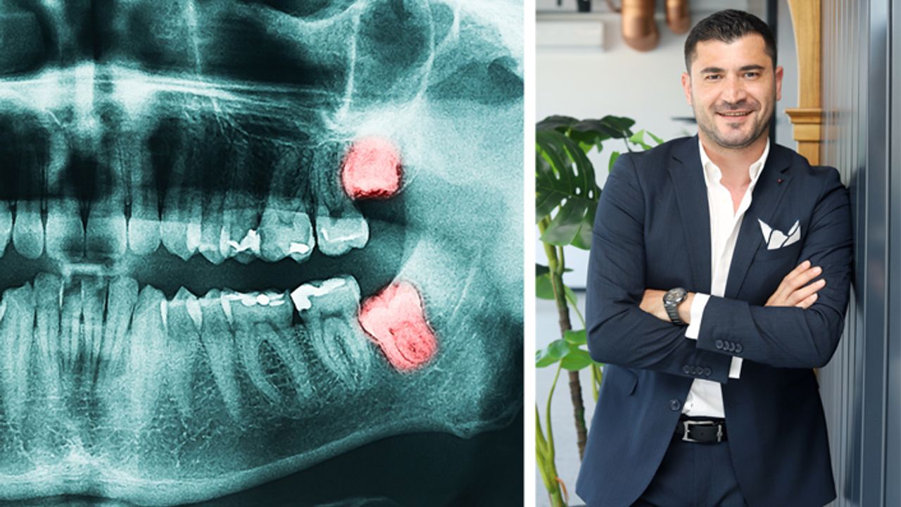 Dr. Dt. Sancar Şimşek: Gömülü dişler cerrahi işlemle alınmalıdır